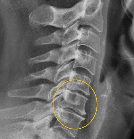 gimdos kaklelio osteochondrozė